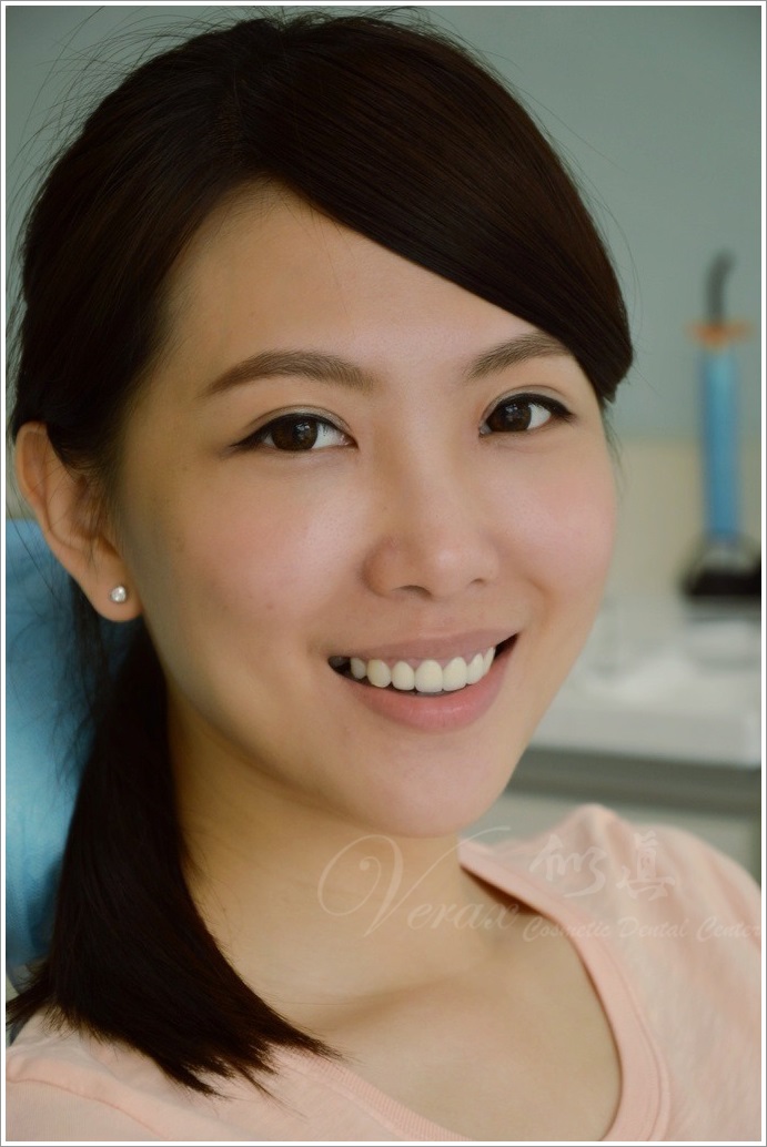 waterlase smile implant tooth dentistry