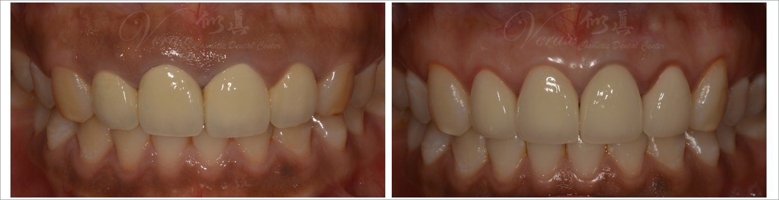 waterlase smile implant tooth dentistry